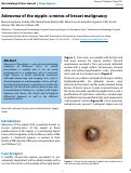 Cover page: Adenoma of the nipple: a mimic of breast malignancy
