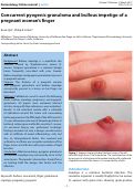 Cover page: Concurrent pyogenic granuloma and bullous impetigo of a pregnant woman’s finger