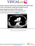 Cover page: Acute, massive pulmonary embolism with right heart strain and hypoxia requiring emergent tissue plasminogen activator (TPA) infusion