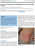 Cover page: A rare case of herpes zoster triggered by a non-live varicella vaccine