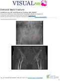 Cover page: Femoral Neck Fracture
