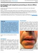 Cover page: Small lymphocytic lymphoma presenting as chronic diffuse lip swelling