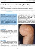 Cover page: Basal cell carcinoma associated with erythema ab igne