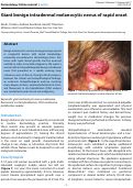 Cover page: Giant benign intradermal melanocytic nevus of rapid onset