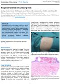 Cover page: Angiokeratoma circumscriptum