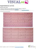 Cover page: Hyperkalemia on ECG