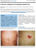 Cover page: Cutaneous collagenous vasculopathy: papular form