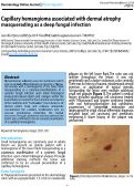 Cover page: Capillary hemangioma associated with dermal atrophy masquerading as a deep fungal infection