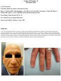 Cover page: Nail lichen planus in a patient with alopecia totalis