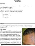 Cover page: Localized and linear lichen planopilaris over the face and scalp with associated alopecia – clinical and dermoscopy pattern